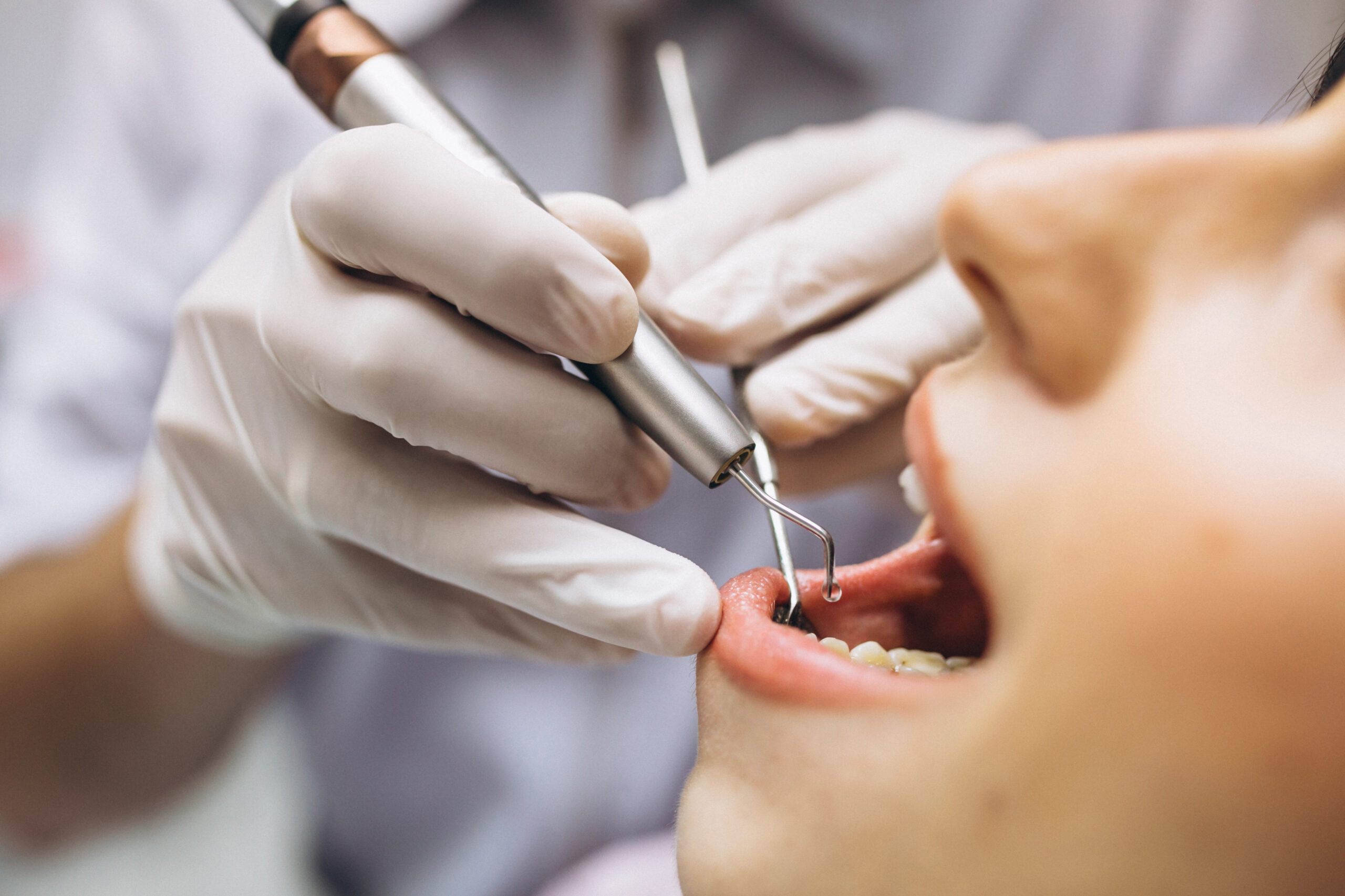 Lee más sobre el artículo LIMPIEZA DENTAL